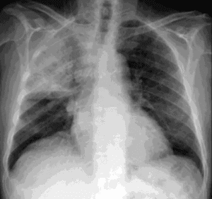 Chest X-ray